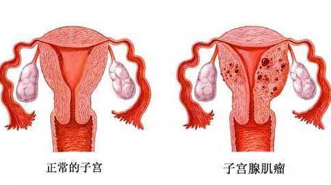 患有子宫腺肌症做泰国试管婴儿能提高受孕几率