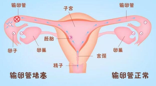 一侧输卵管堵塞还有50%几率可以成功怀孕 真的吗？