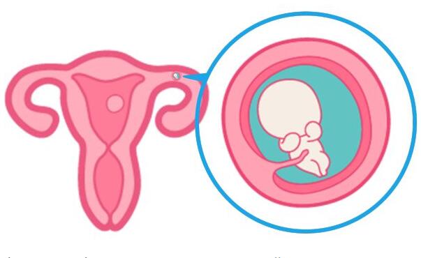 宫外孕做泰国试管