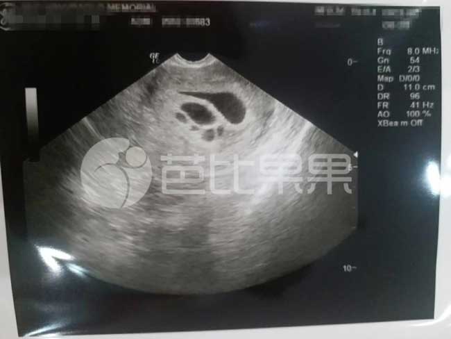 泰国孕妈B超报告