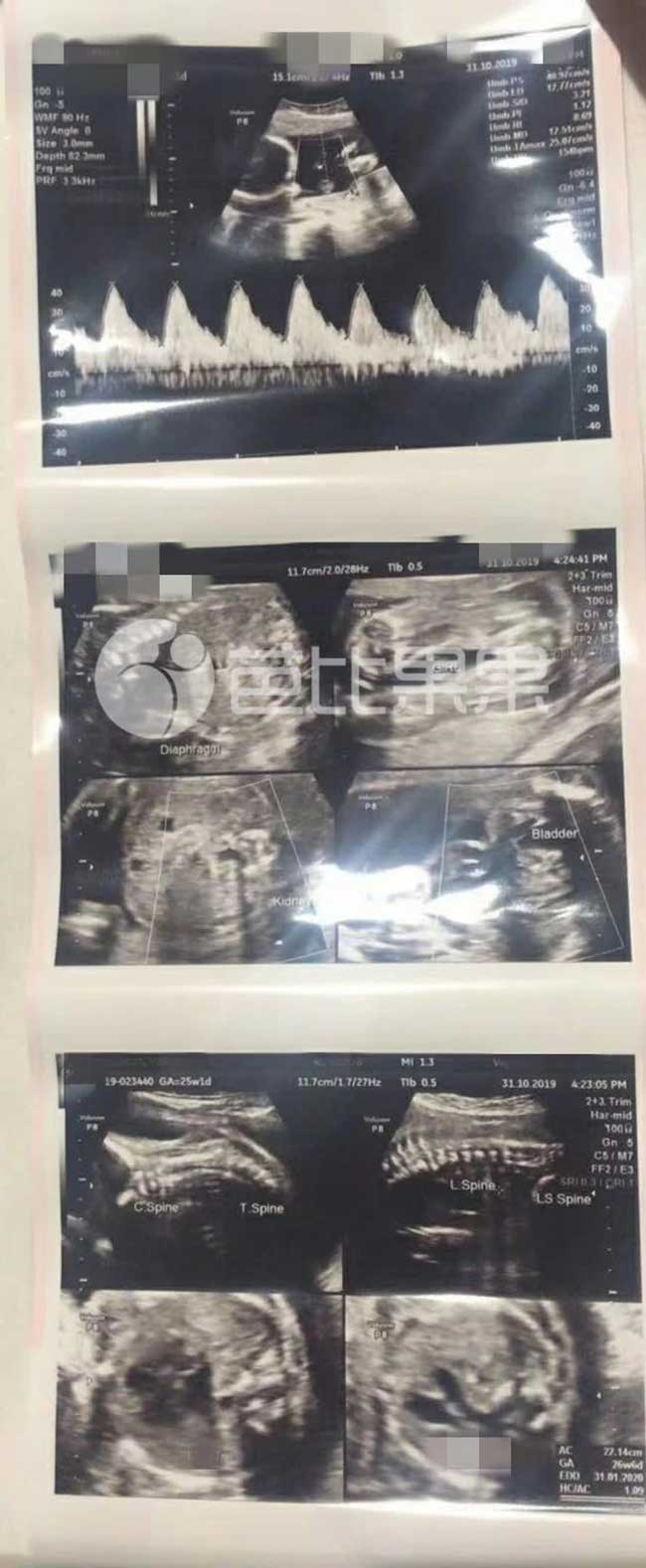 R小姐的泰国试管助孕怀孕25周在妇科医院做四维彩超