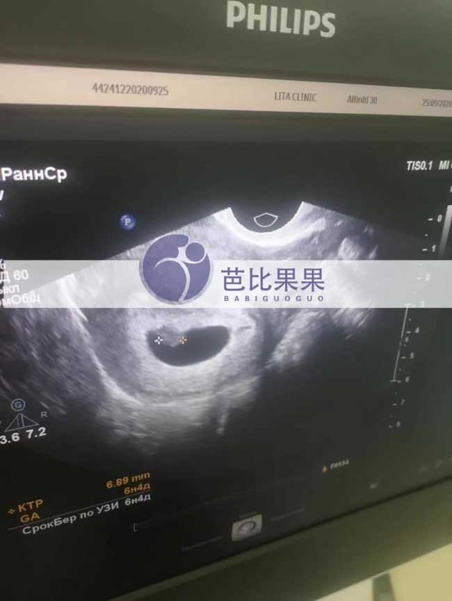 乌克兰试管代妈B超检查