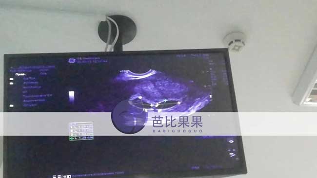 Z先生乌克兰试管在怀孕6周的时候做B超