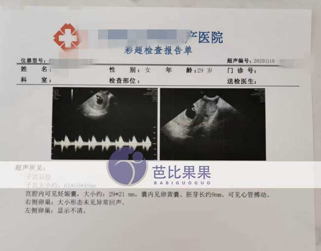 H女士在国内慈铭博鳌医院做三代试管第一次B超确认宫内早孕