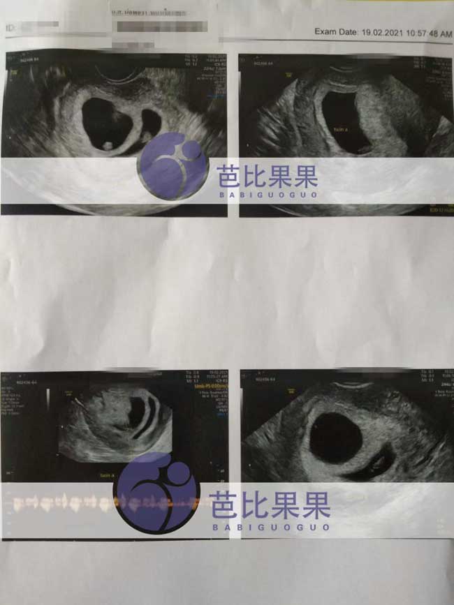 泰国试管代妈做B超