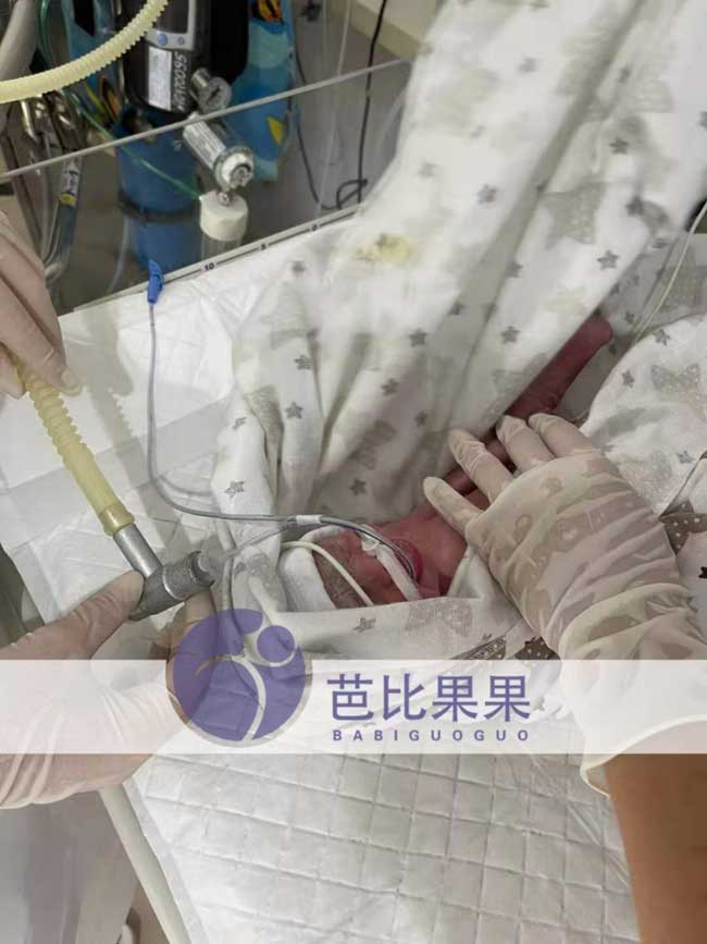 X先生在乌克兰试管顺利生下早产儿