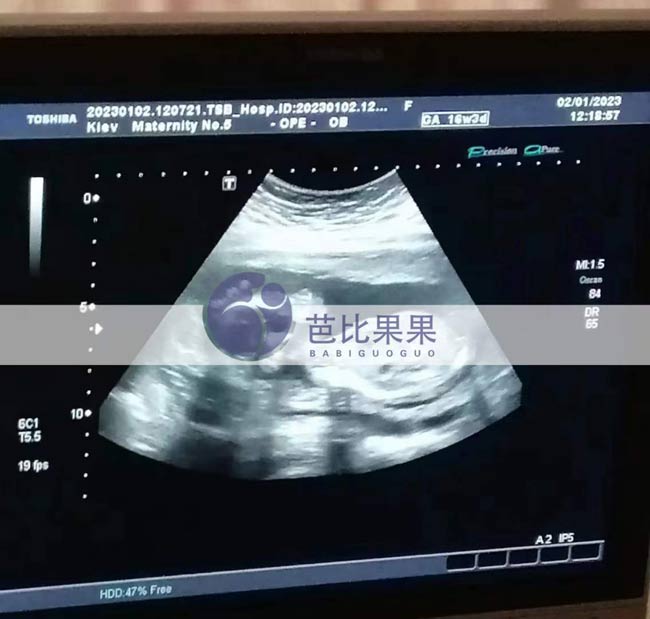 试管妈妈产检