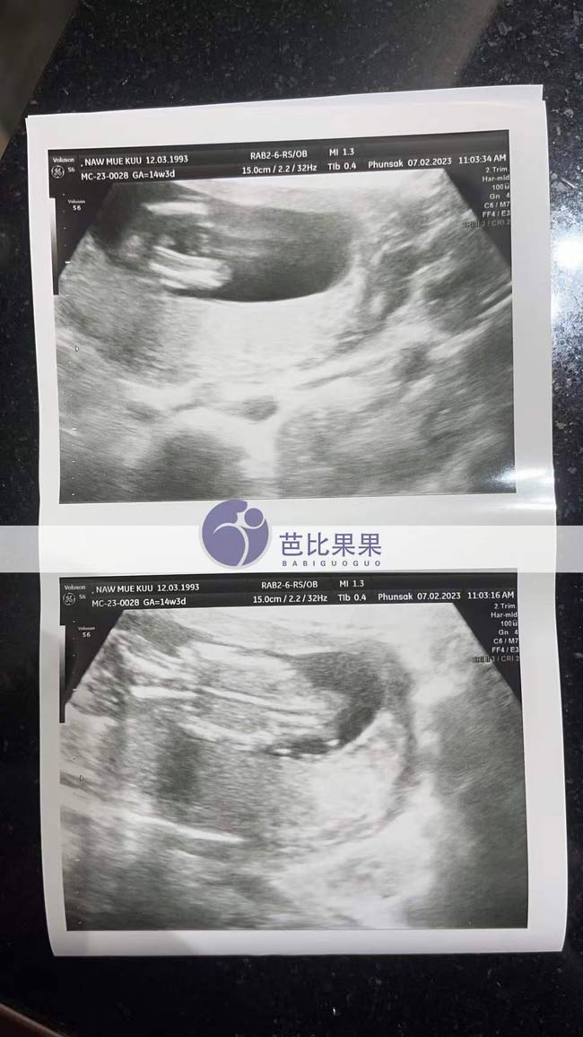 泰国三代试管孕14周产检