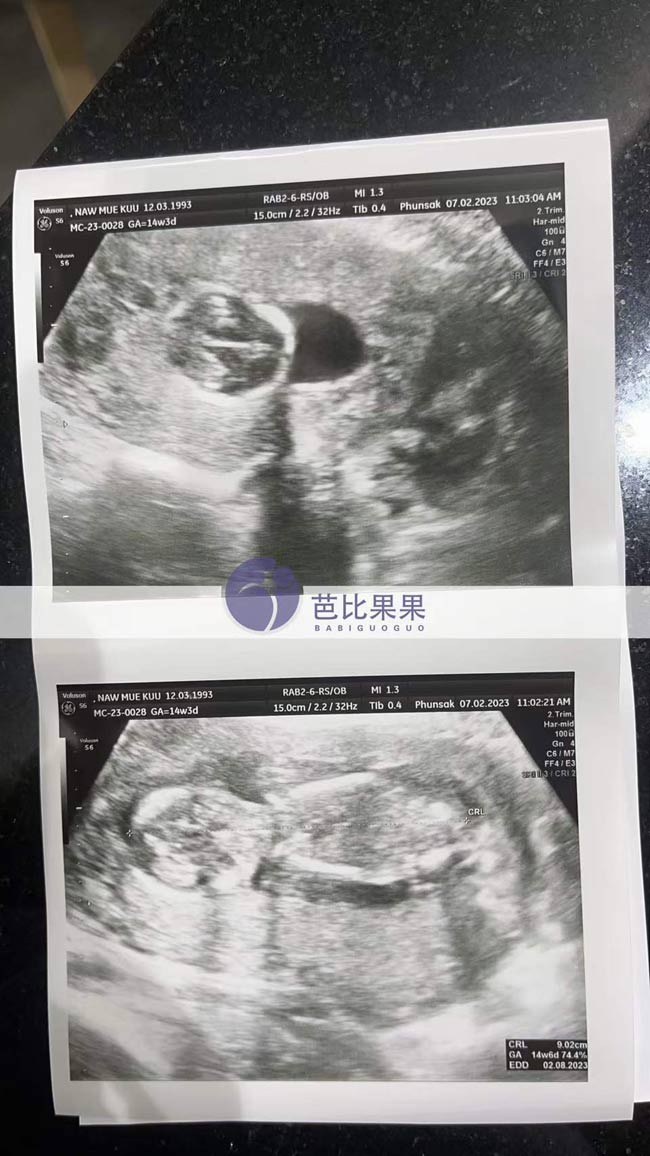 泰国三代试管孕14周产检