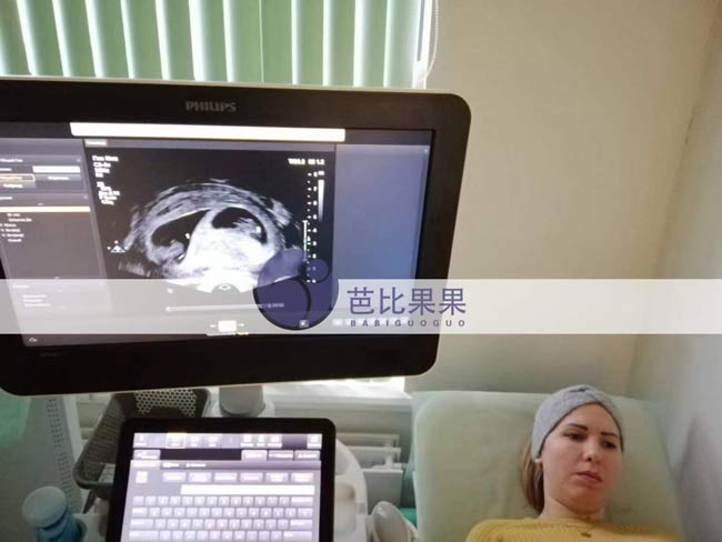 Z女士家乌克兰试管妈妈来Lita丽塔医院做首次B超检查