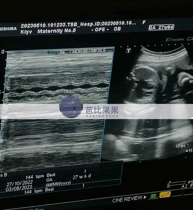 乌克兰试管妈妈孕27周B超