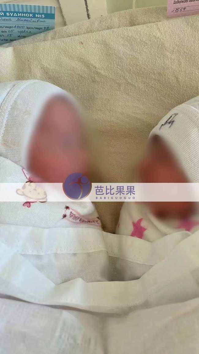 义乌Z女士家的乌克兰试管龙凤胎宝宝顺利出生，孕38周生产