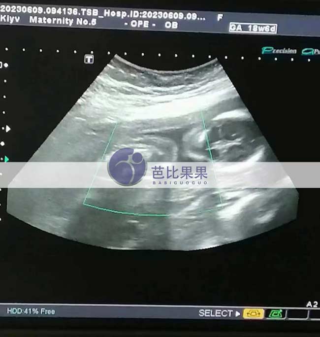 乌克兰试管妈妈孕18周B超