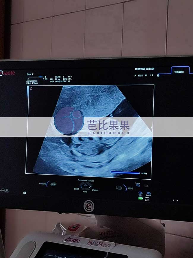 试管妈妈孕13周B超