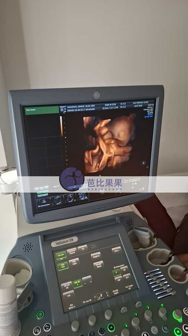 试管妈妈做四维彩超
