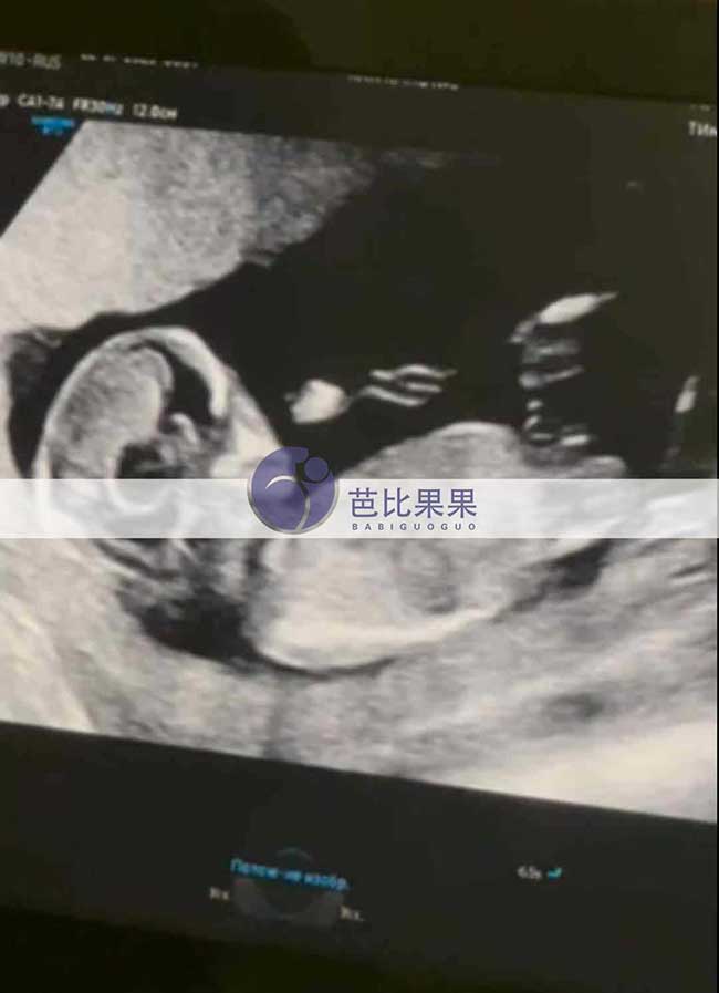 试管妈妈做B超