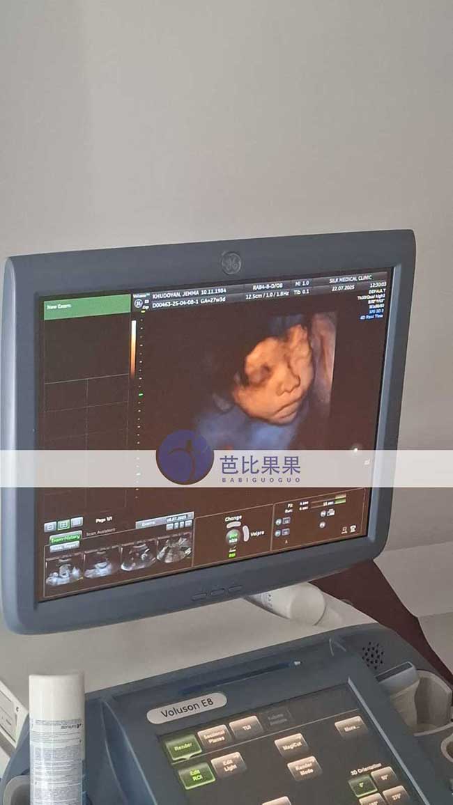 试管妈妈做四维彩超
