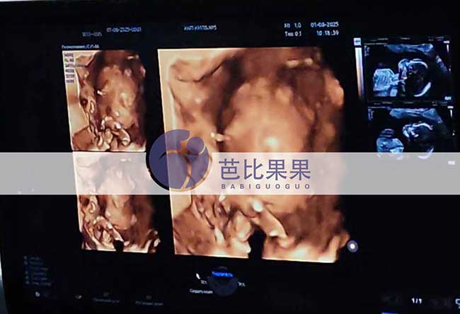 试管妈妈做四维彩超