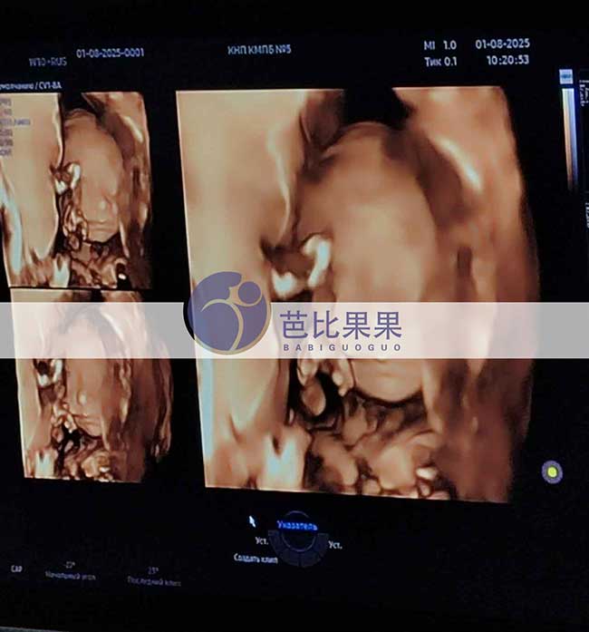 试管妈妈做四维彩超