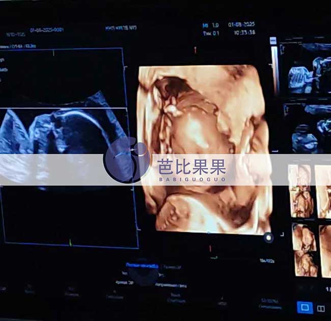 试管妈妈做四维彩超
