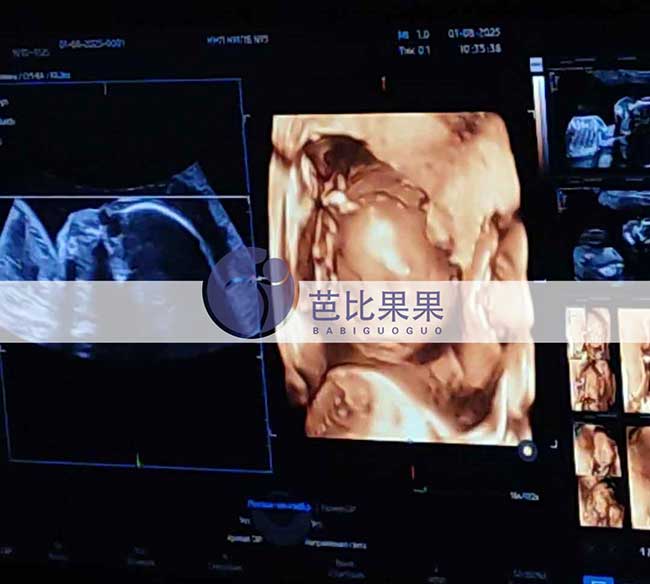 试管妈妈做四维彩超