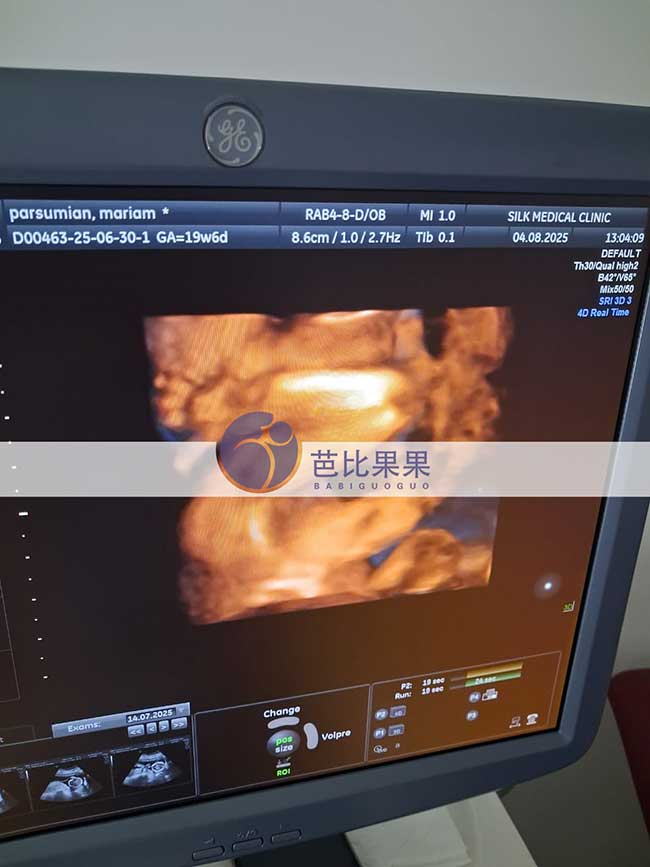试管妈妈做四维彩超