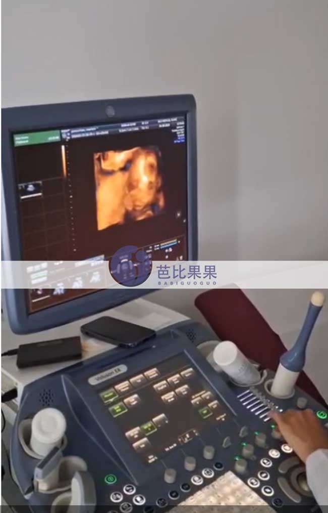 试管妈妈做四维彩超