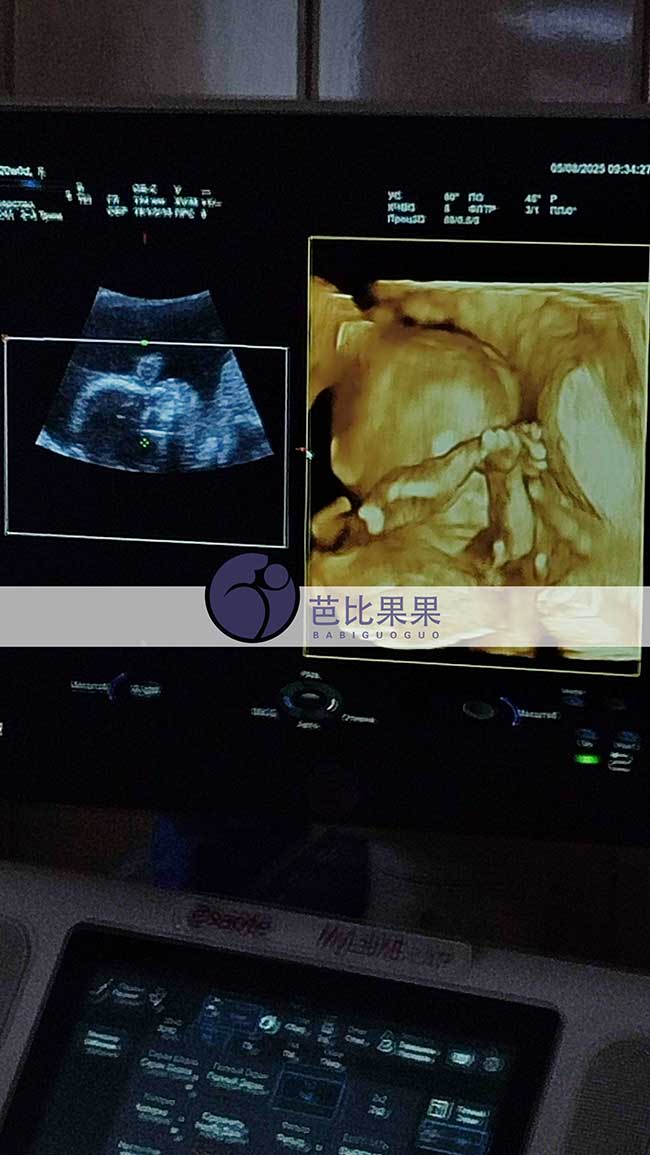 试管妈妈做四维彩超