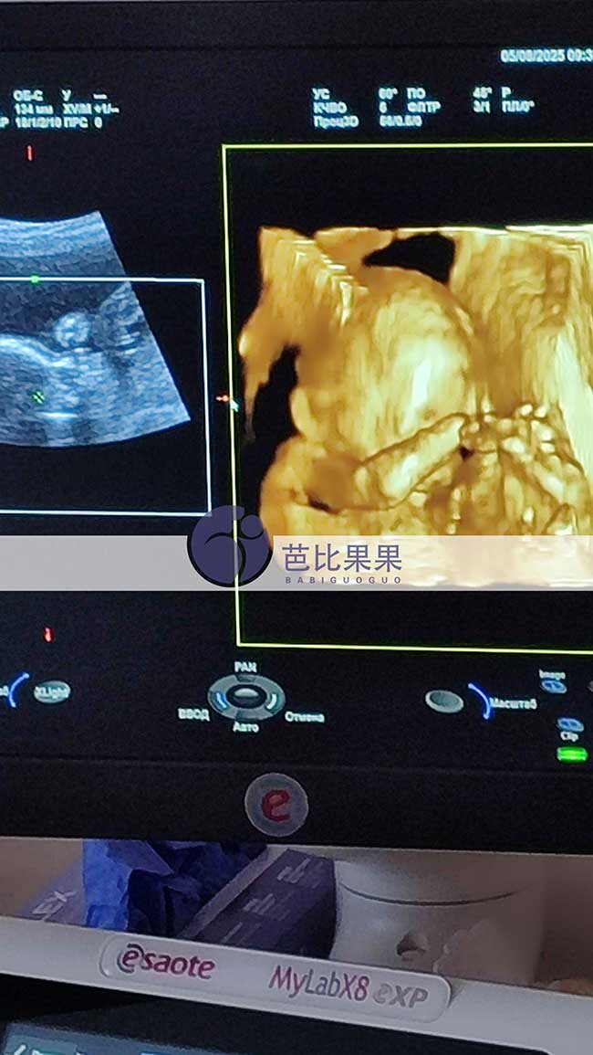 试管妈妈做四维彩超