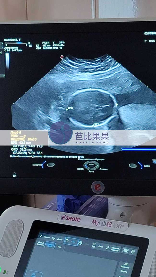 试管妈妈做B超