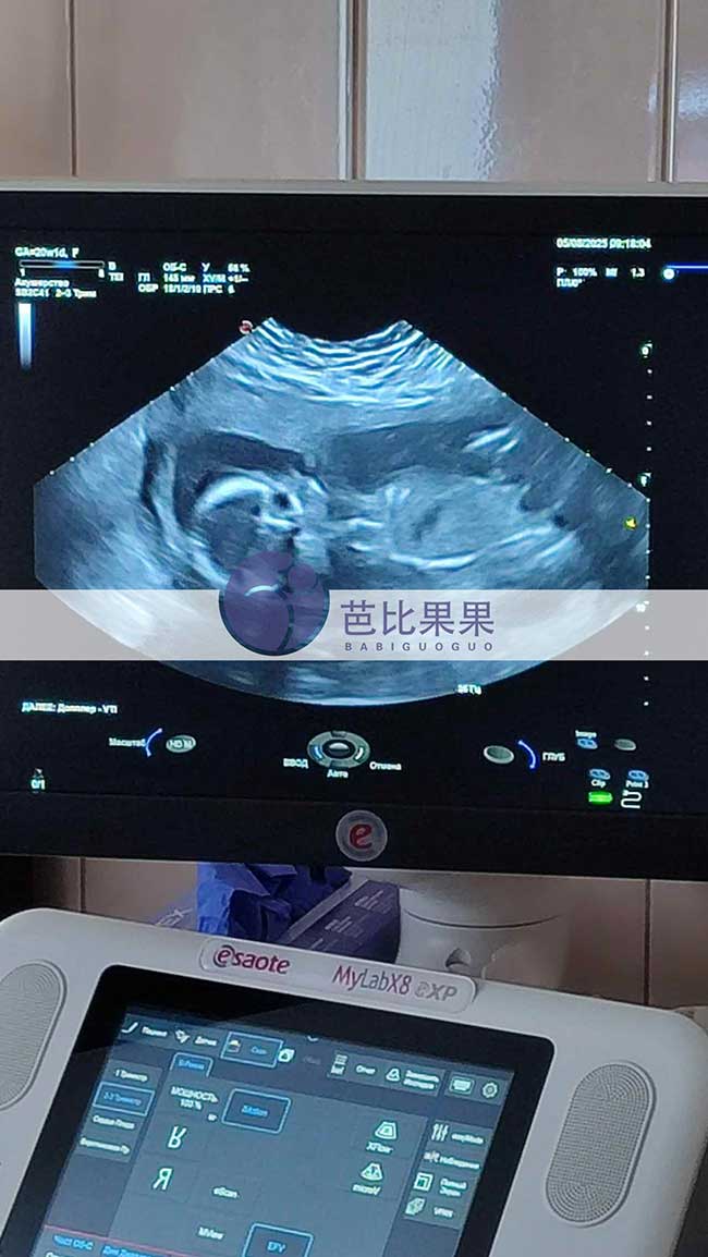试管妈妈做B超