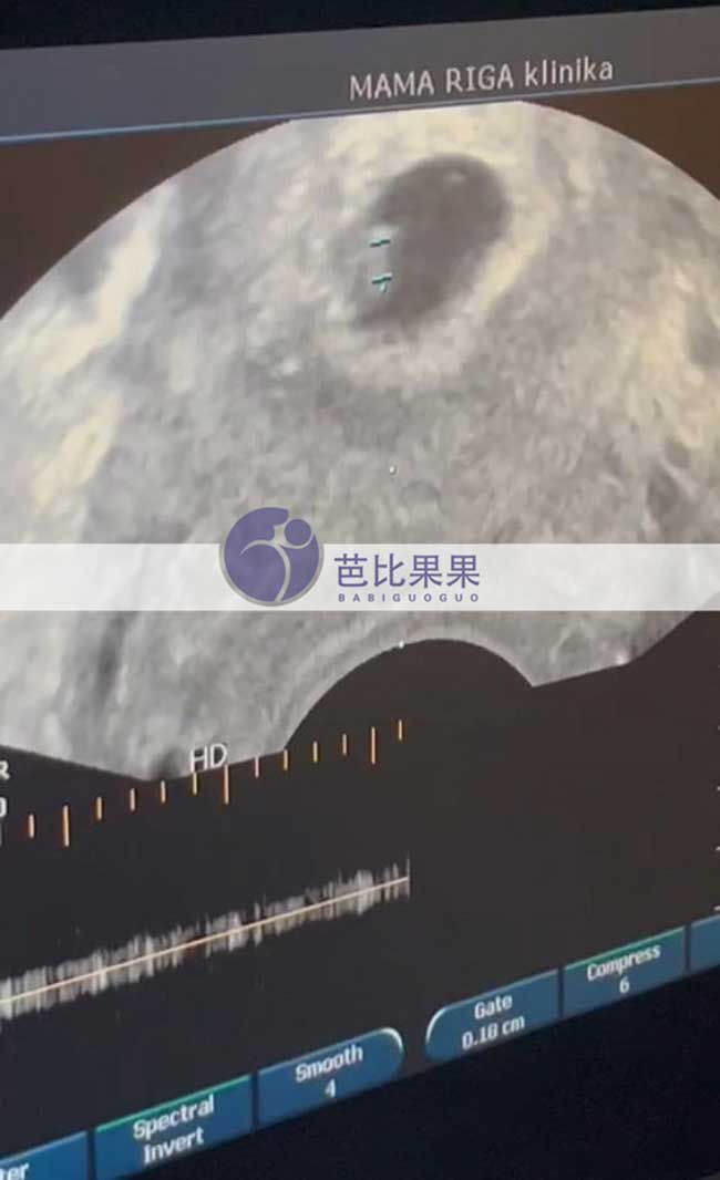 试管妈妈首次B超