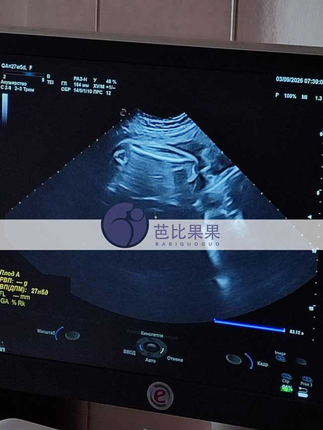 试管妈妈做B超