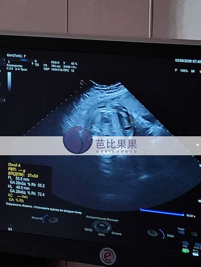 试管妈妈做B超