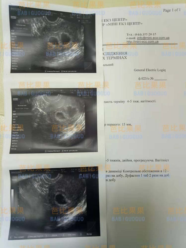 38岁多囊卵巢选乌克兰mini医院试管助孕生龙凤胎案例
