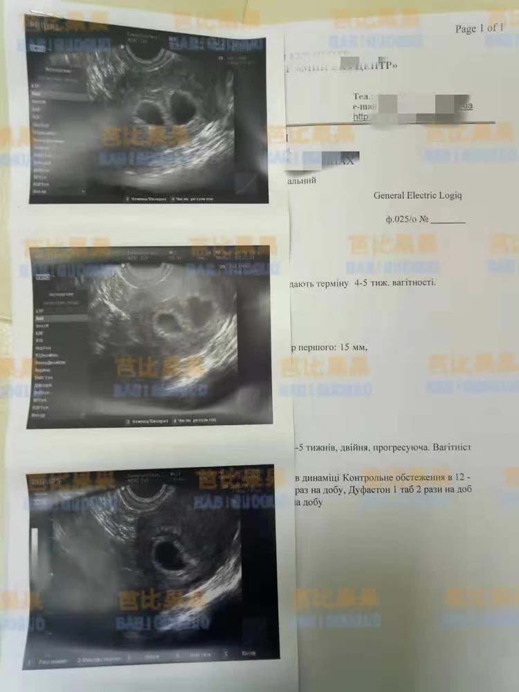 客户选乌克兰mini医院做sgm首次B超证实着床了双胞胎