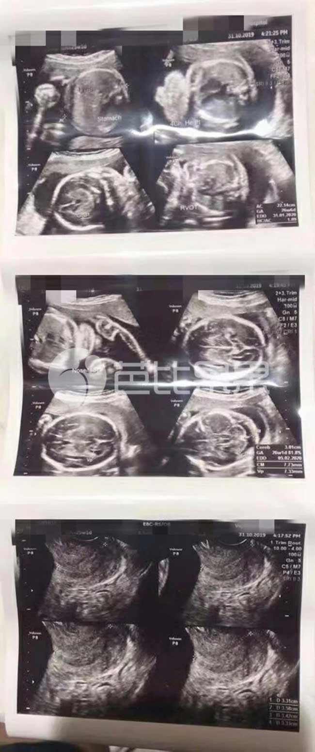 r小姐的泰国试管助孕怀孕25周在妇科医院做四维彩超