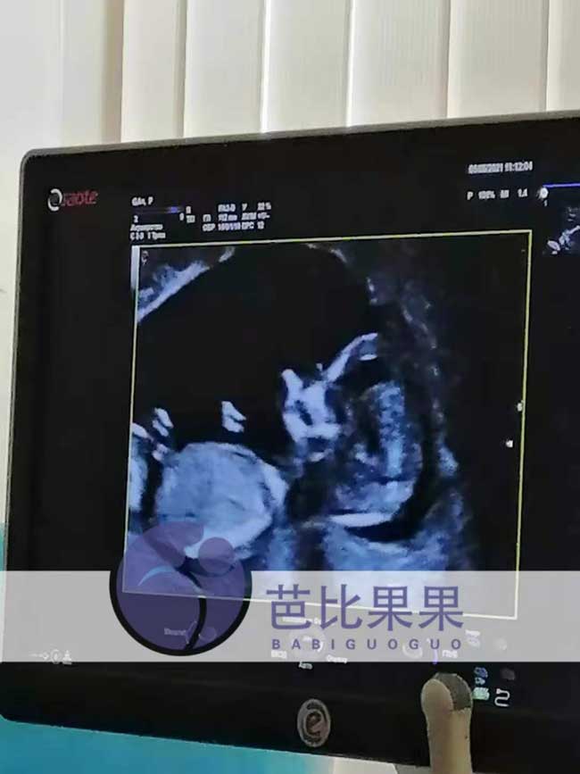 乌克兰试管代妈做产检