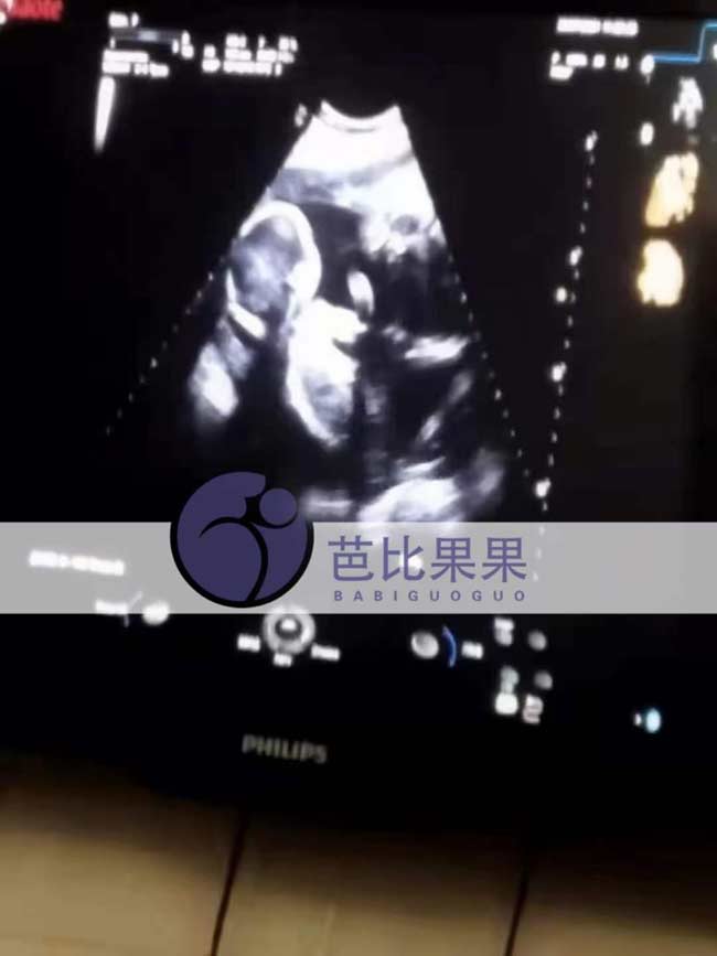 乌克兰试管孕母去医院产检