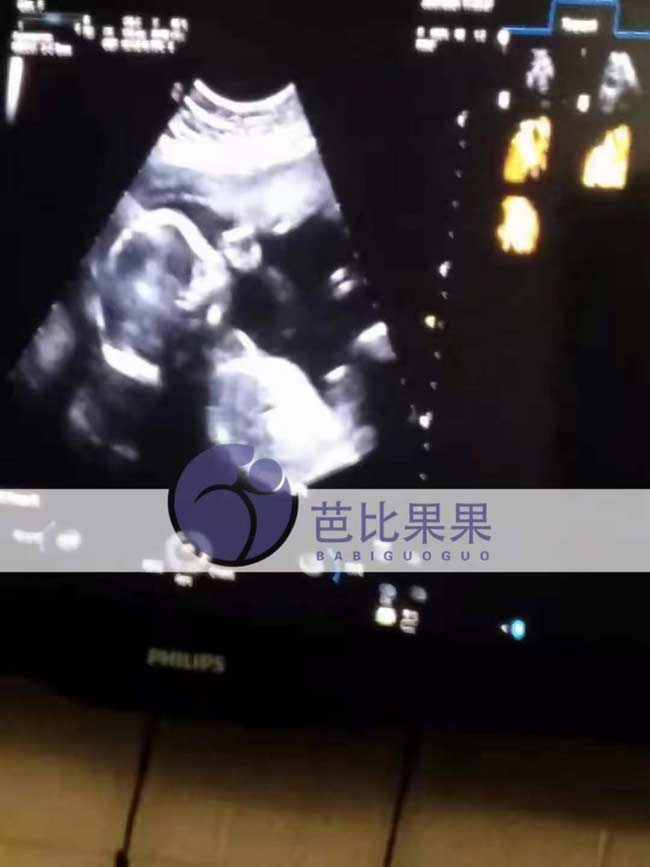乌克兰试管孕母去医院产检