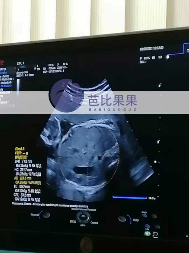 乌克兰孕妈28周B超