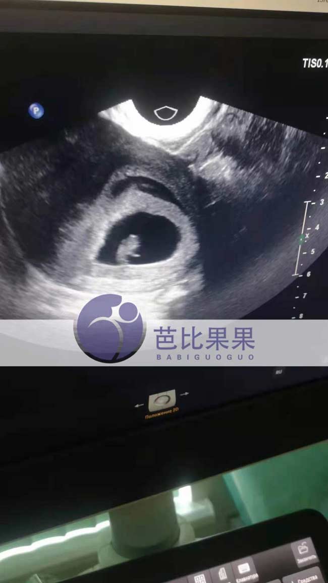 乌克兰孕妈首次B超