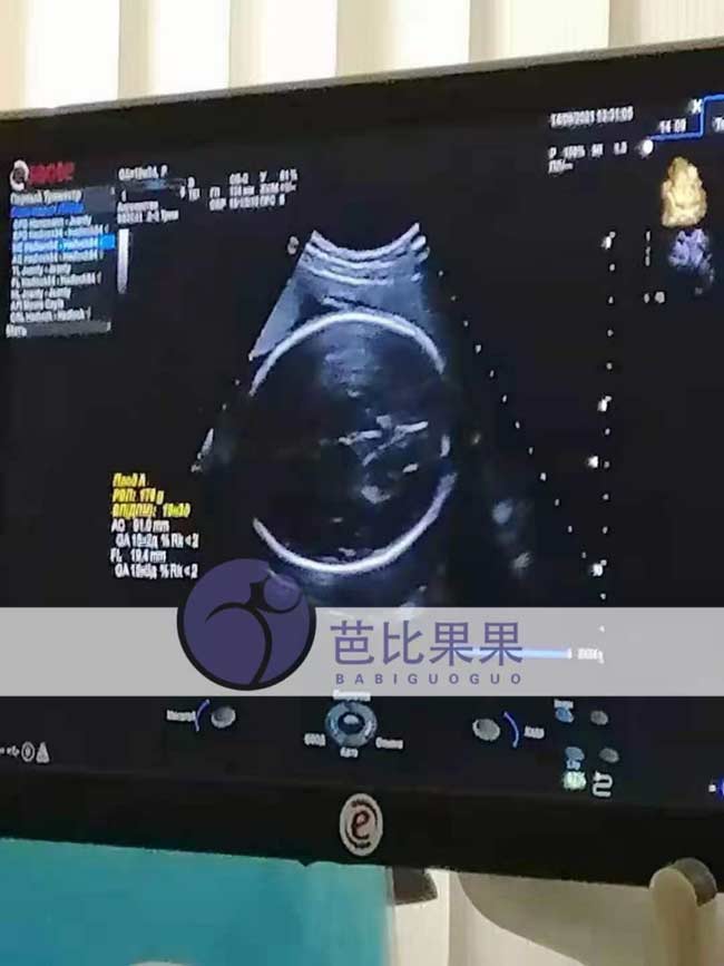乌克兰孕妈32周B超