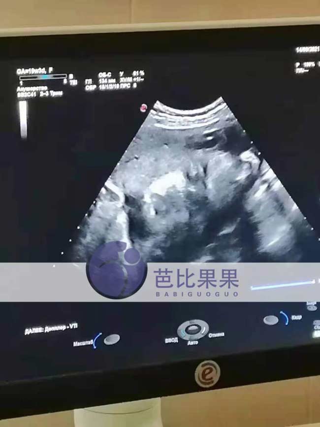 乌克兰孕妈32周B超