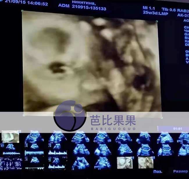 乌克兰孕妈做四维彩超