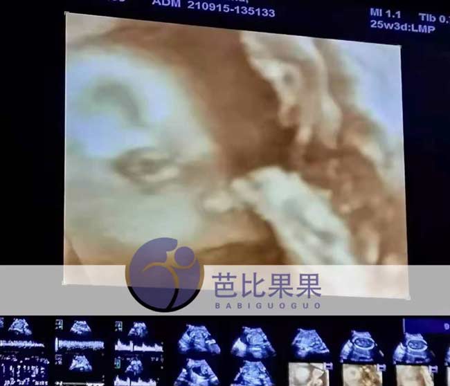 乌克兰孕妈做四维彩超