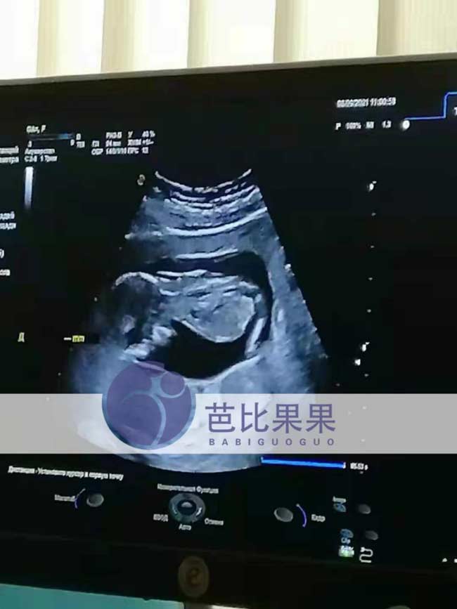 乌克兰孕妈做产检