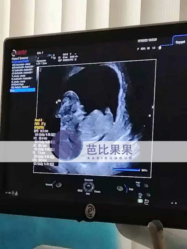 乌克兰试管孕妈B超