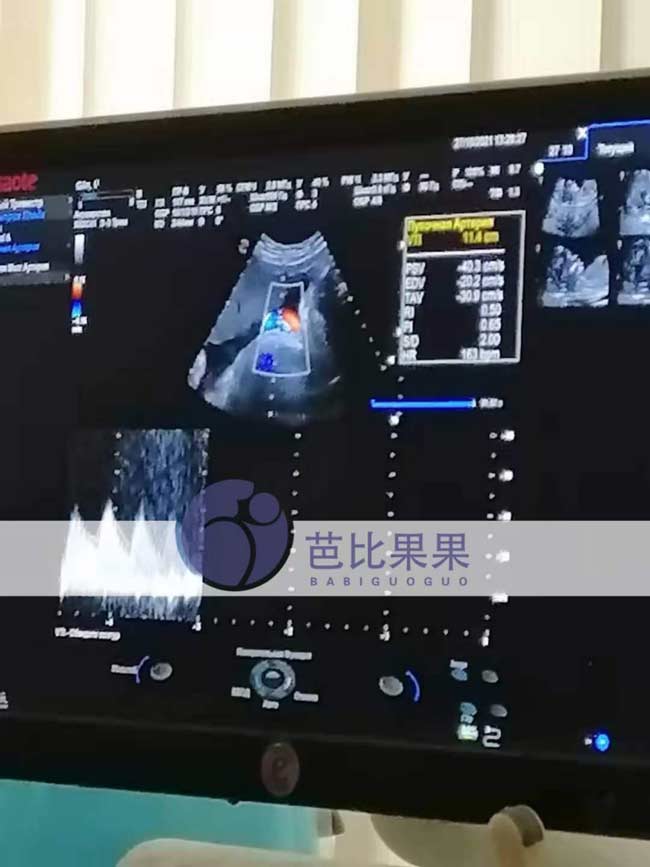乌克兰试管孕妈38周B超
