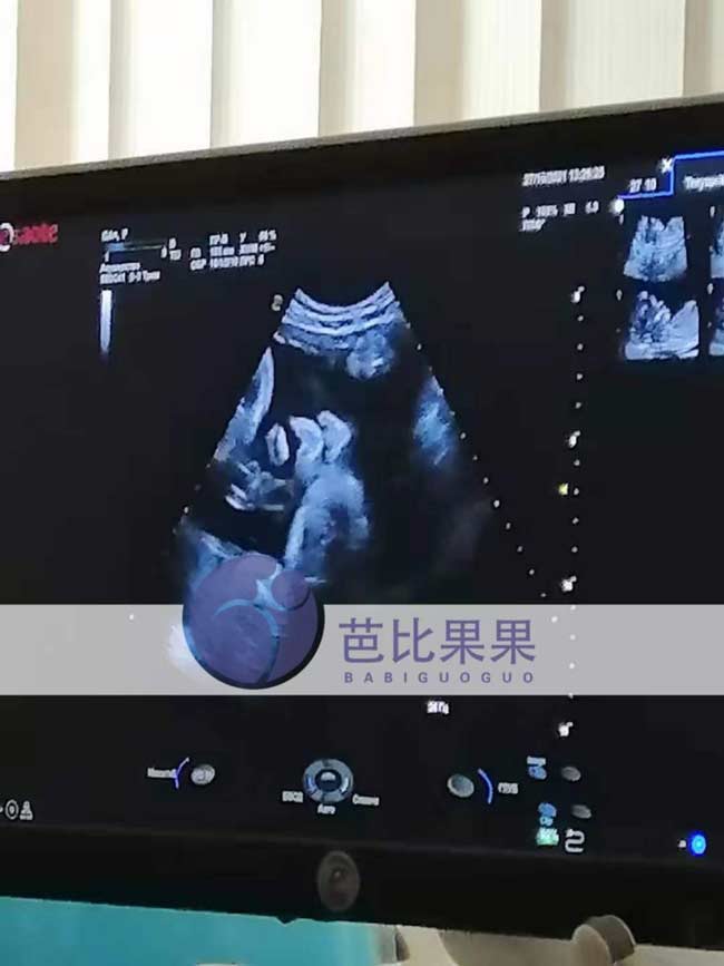 乌克兰试管孕妈38周B超